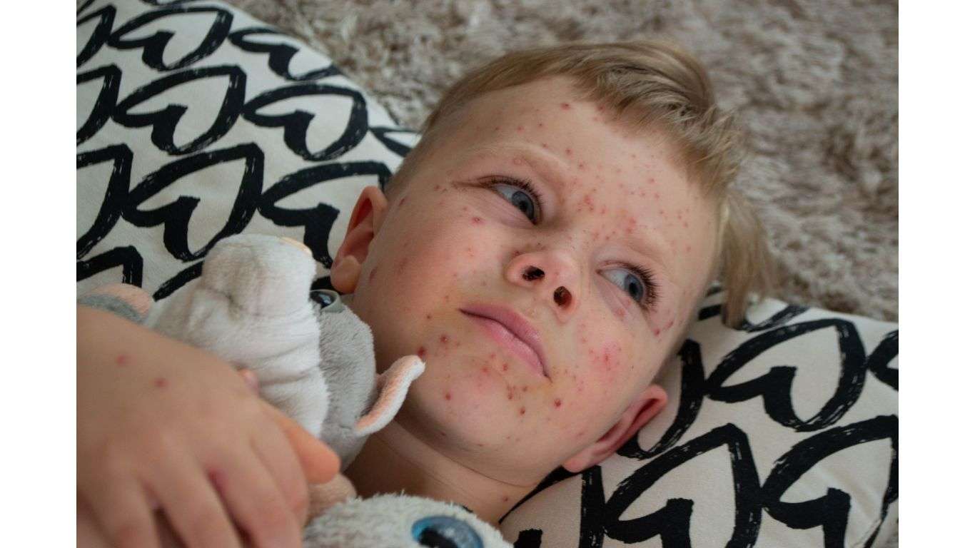 Children suffering from mold exposure